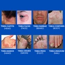 hermon-powerful-antifungal-ringworm-crea-6.jpg